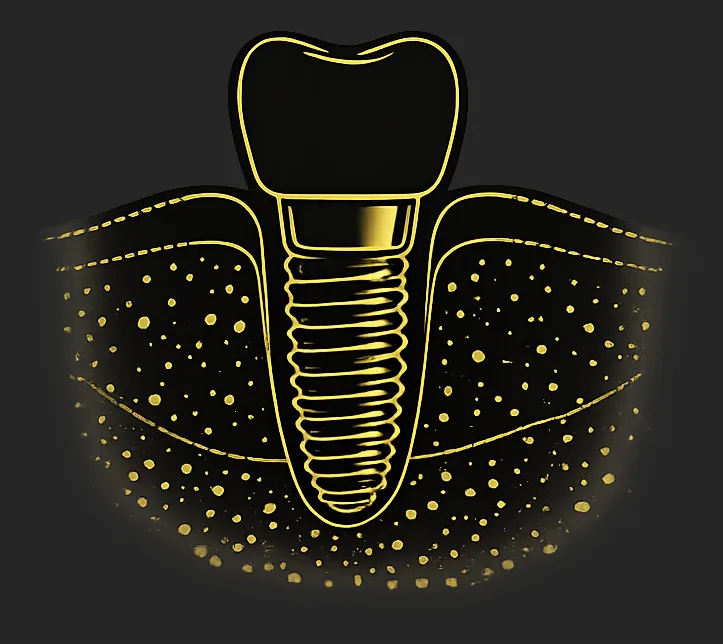 Implantes Dentales