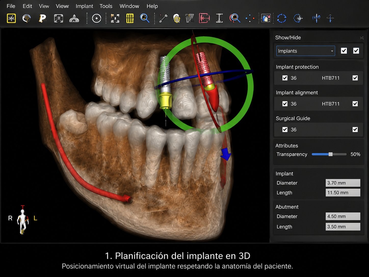 Planificación 3D del implante
