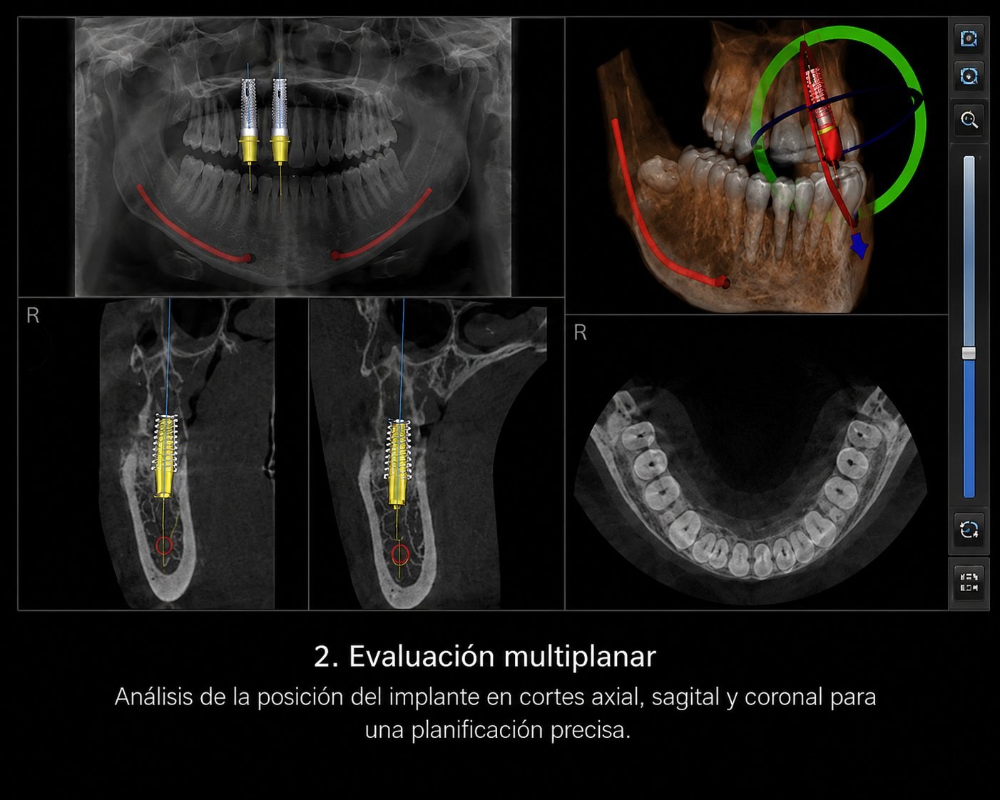 Evaluación multiplanar implantes