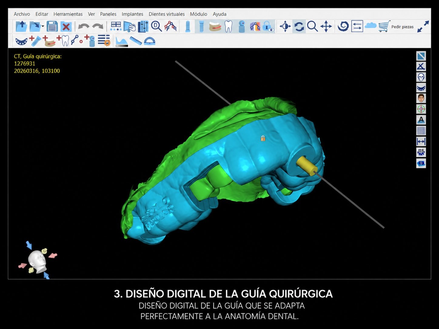 Diseño digital guía quirúrgica