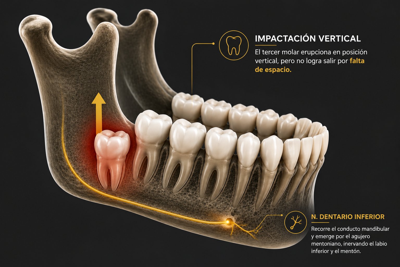 Impactación vertical — tercer molar