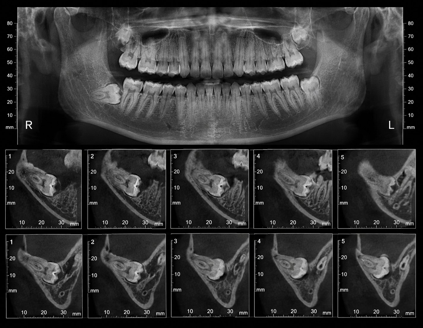 Tomografía 3D — terceros molares
